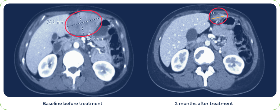 Case 3: Patient treated with combination of gotistobart and pembrolizumab